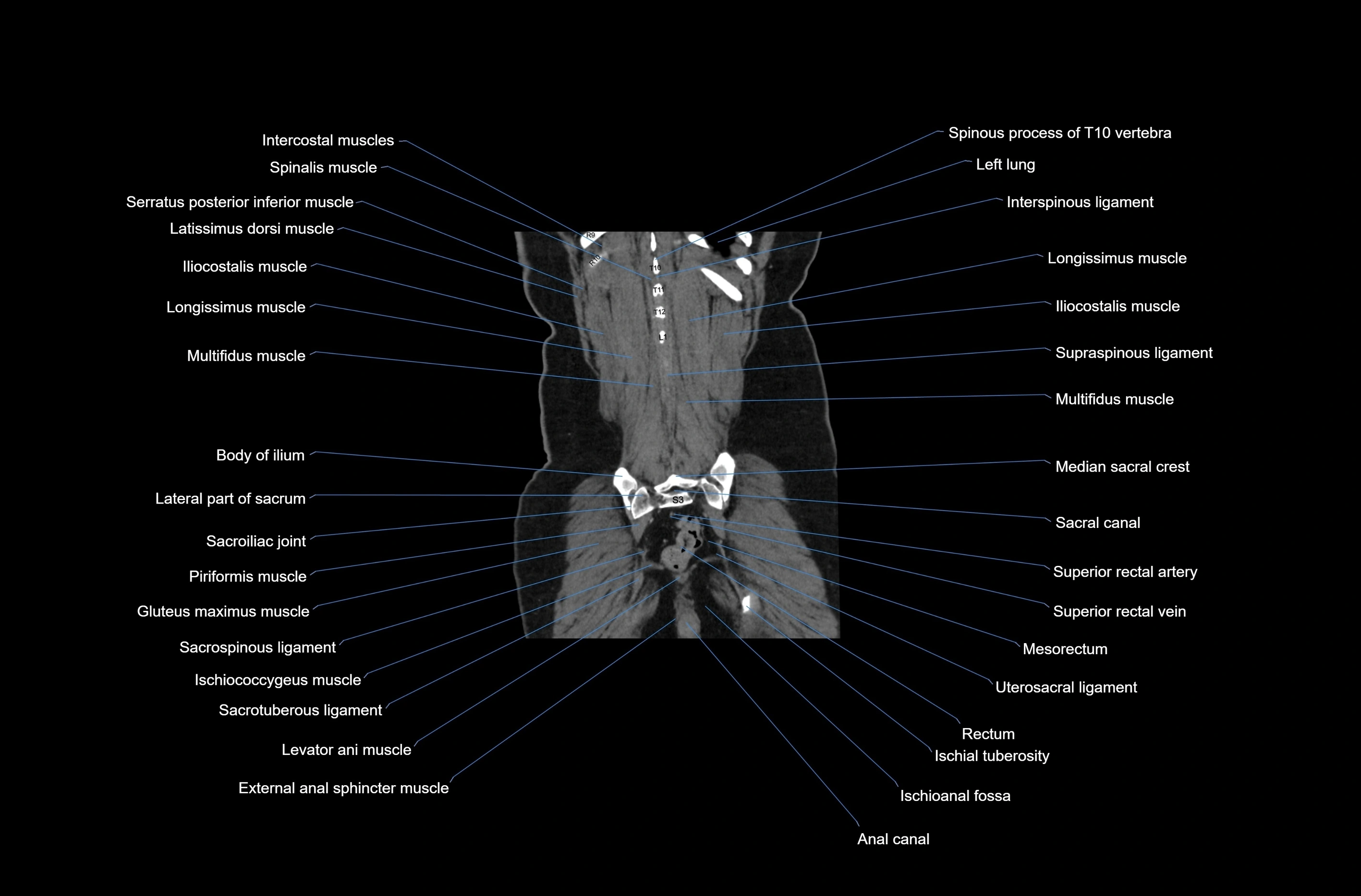 CT abdomen coronal cross sectional anatomy labelled radiology image-00074.webp